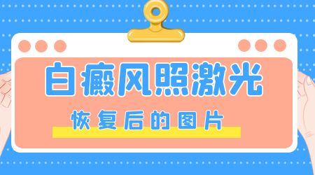 腰部白癜风-腰部白癜风患者检查需要注意哪些问题呢？